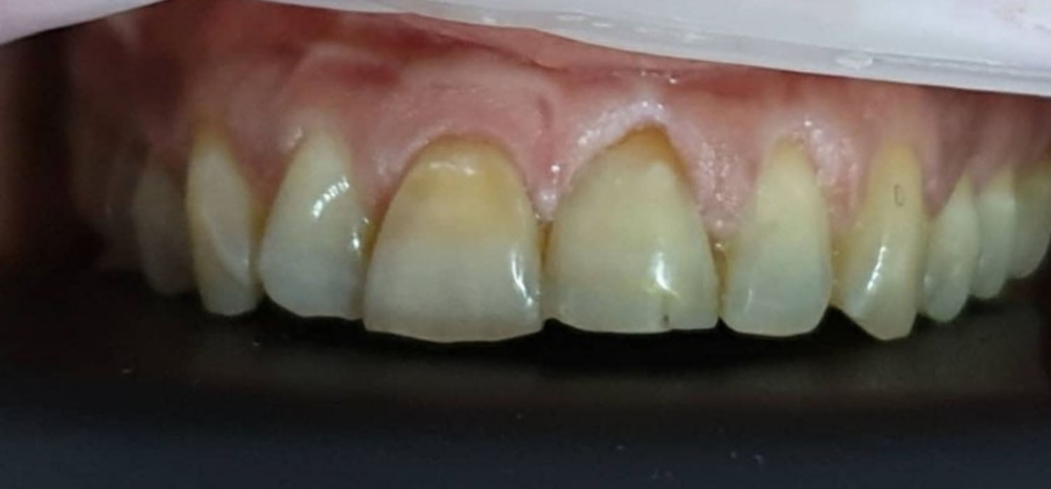 porseleinen facings